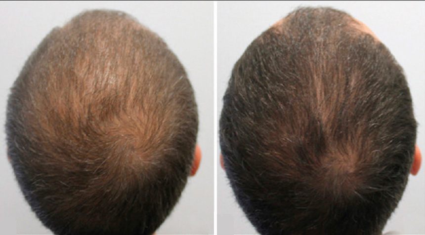 La mesoterapia con dutasteride es la solución contra la alopecia con la