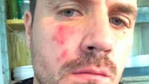 como-eliminar-la-rosacea-de-la-piel-de-la-cara