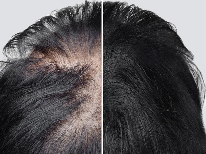 exosomas-alopecia-antes-despues-defelipe