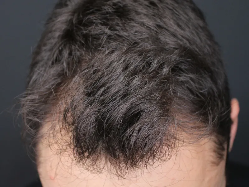 exosomas-alopecia-clinica-robega-tratamiento