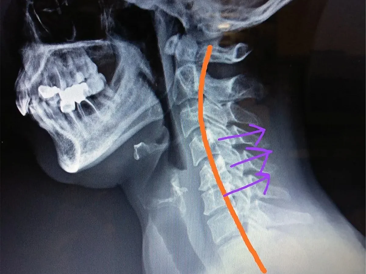 radiografía de la rectificación cervical