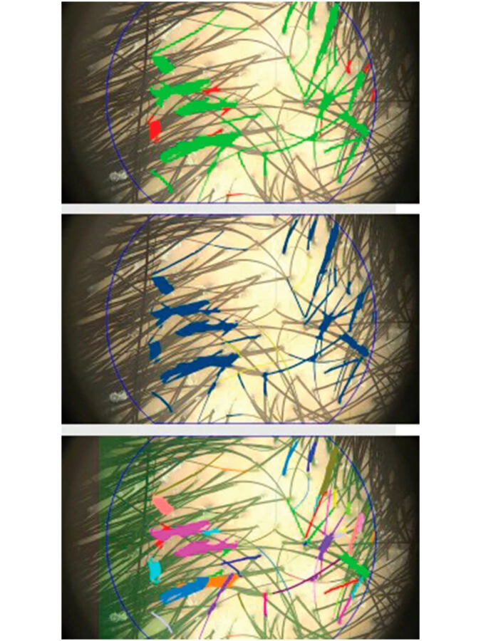 Imágenes representativas de un test tricológico del estudio, con folículos y cabellos marcados con colores para su análisis.