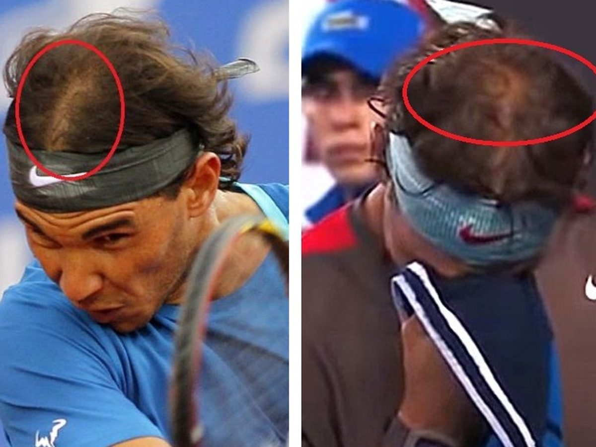 Dos imágenes de Rafa Nadal en las que se evidencia la pérdida de densidad capilar del tenista durante un partido.