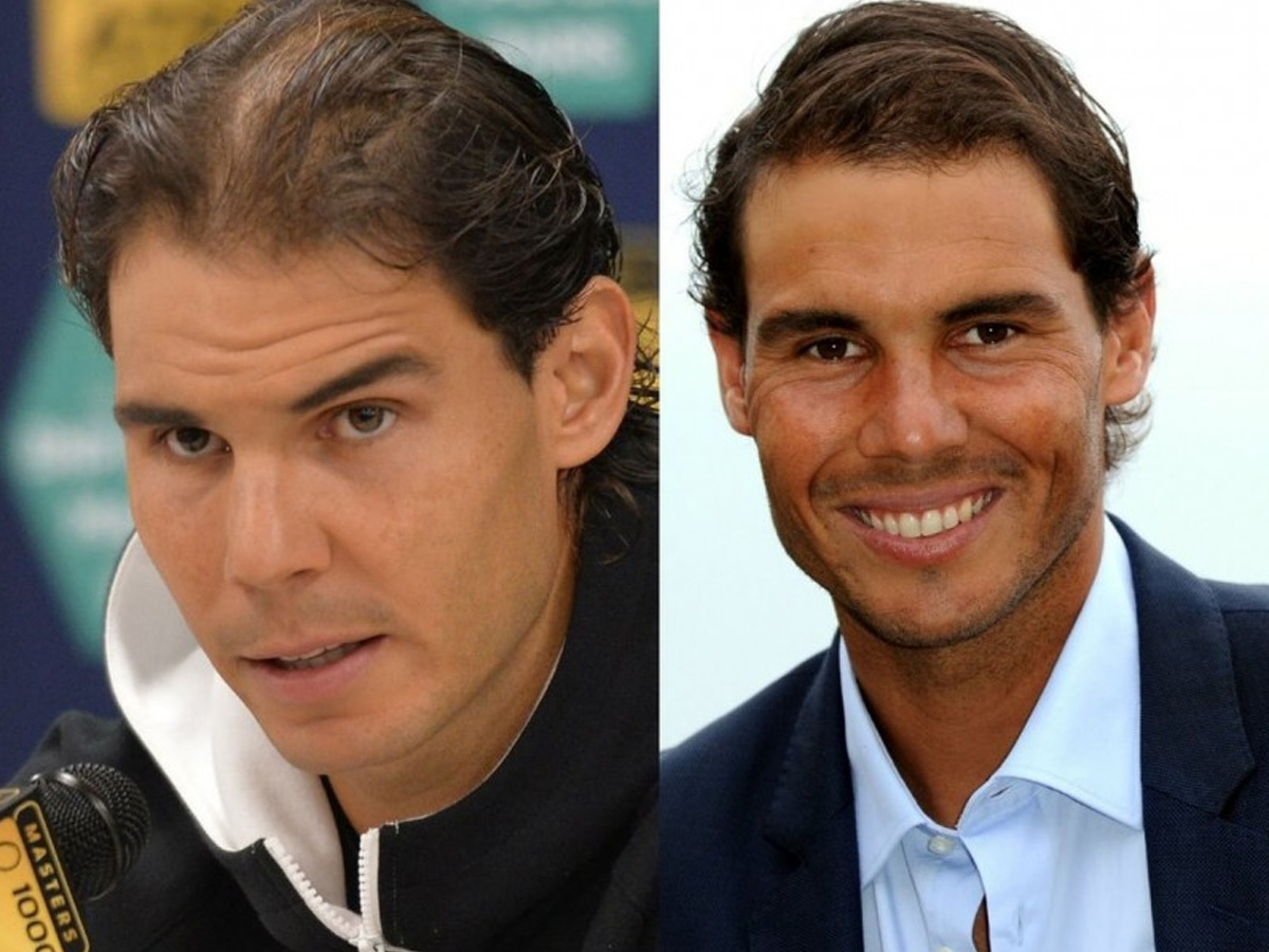 Dos imágenes de Rafa Nadal, a la izquierda con una notable pérdida de pelo y a la derecha con más pelo tras su injerto capilar.