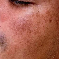 Cómo eliminar las manchas de la cara después del verano: los 4 tratamientos para hombre que realmente funcionan Rostro de hombre con manchas en la piel