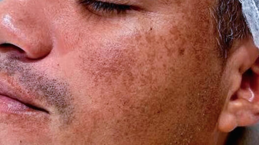 Rostro de hombre con manchas en la piel