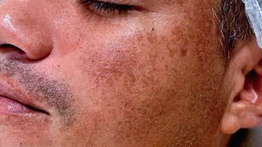 Rostro de hombre con manchas en la piel