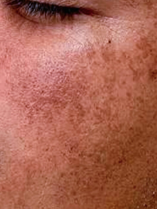 Rostro de hombre con manchas en la piel