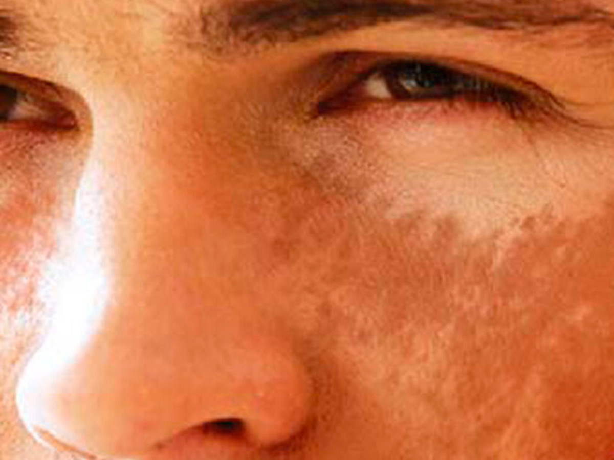 rostro hombre mancha en la piel